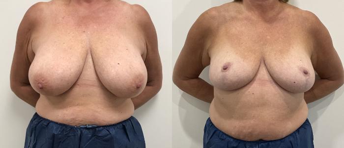 Before & After Breast Reduction Case 418 Front View in Barrington, Illinois