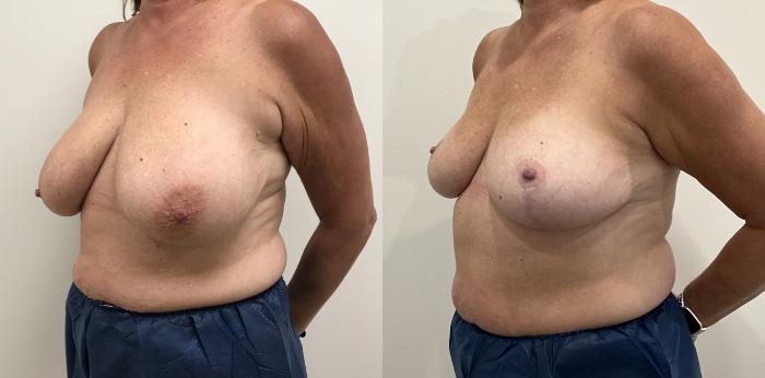 Before & After Breast Reduction Case 418 Left Oblique View in Barrington, Illinois