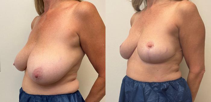 Before & After Breast Reduction Case 424 Left Oblique View in Barrington, Illinois