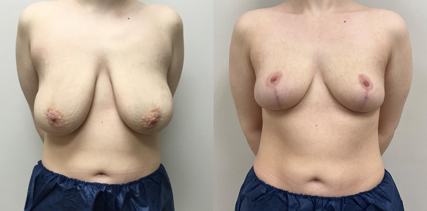 Before & After Breast Reduction Case 430 Front View in Barrington, Illinois