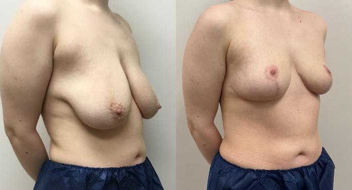 Before & After Breast Reduction Case 430 Right Oblique View in Barrington, Illinois