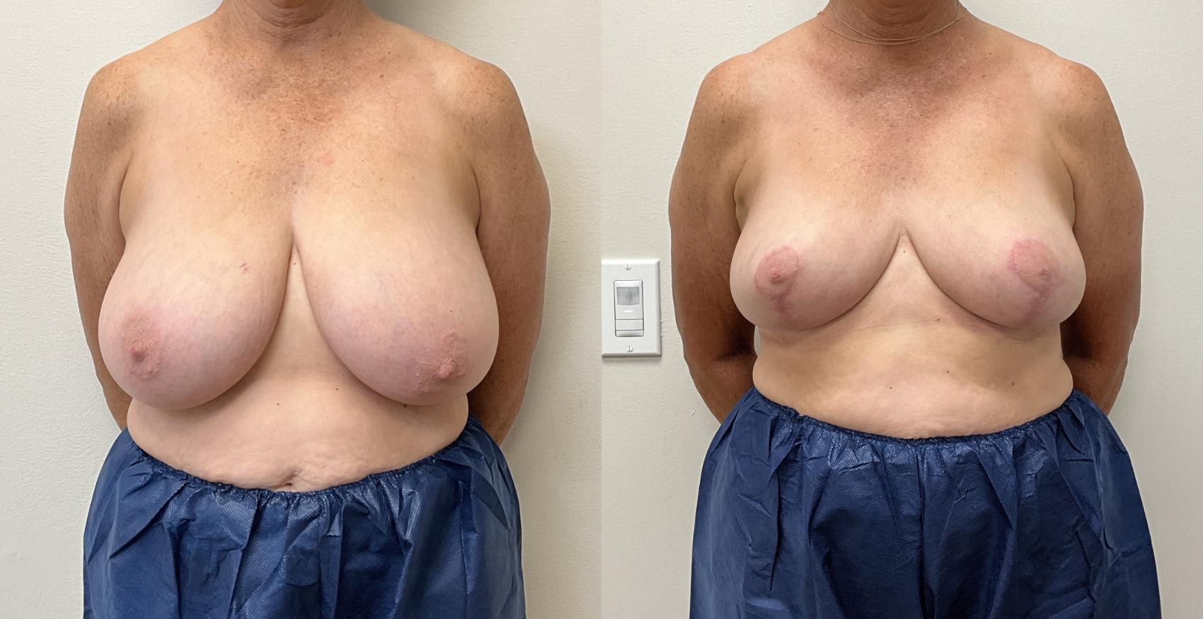 Before & After Breast Reduction Case 442 Front View in Barrington, Illinois