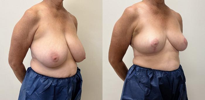 Before & After Breast Reduction Case 442 Right Oblique View in Barrington, Illinois