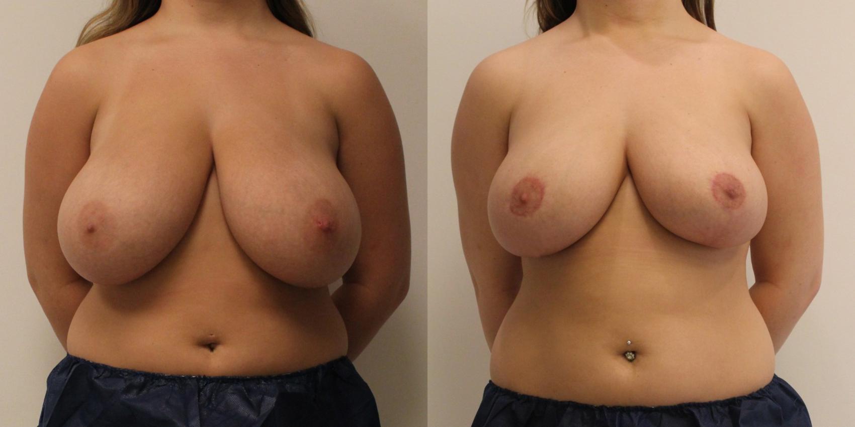 Before & After Breast Reduction Case 60 View #1 View in Barrington, Illinois