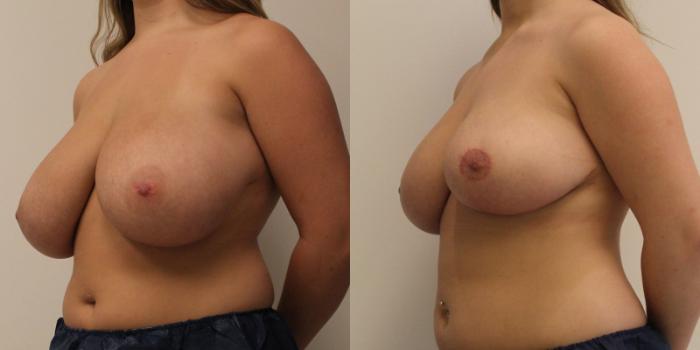 Before & After Breast Reduction Case 60 View #2 View in Barrington, Illinois