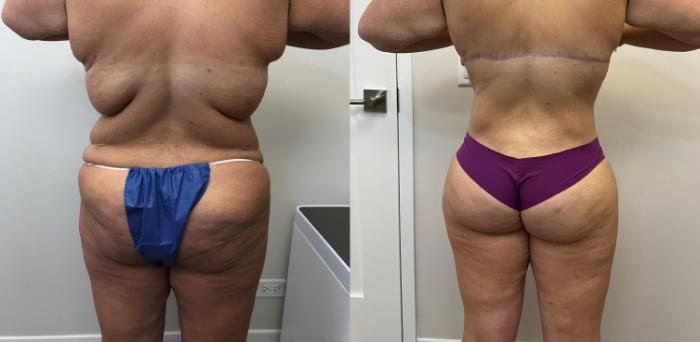 Before & After Circumferential Body Lift  Case 373 Back View in Barrington, Illinois