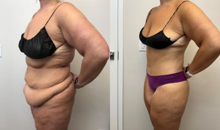 Before & After Circumferential Body Lift  Case 373 Left Oblique View in Barrington, Illinois