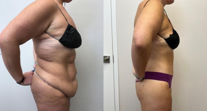 Before & After Circumferential Body Lift  Case 373 Right Side View in Barrington, Illinois