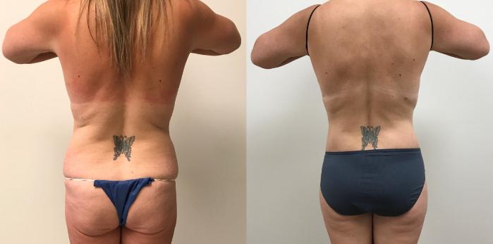 Before & After Circumferential Body Lift  Case 374 Back View in Barrington, Illinois