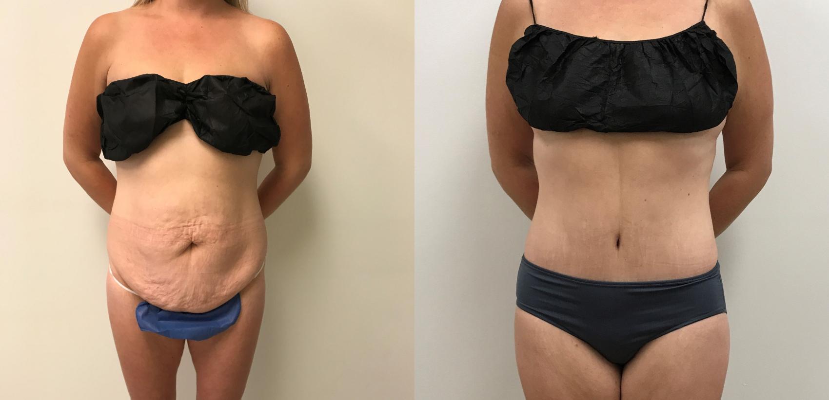 Before & After Circumferential Body Lift  Case 374 Front View in Barrington, Illinois