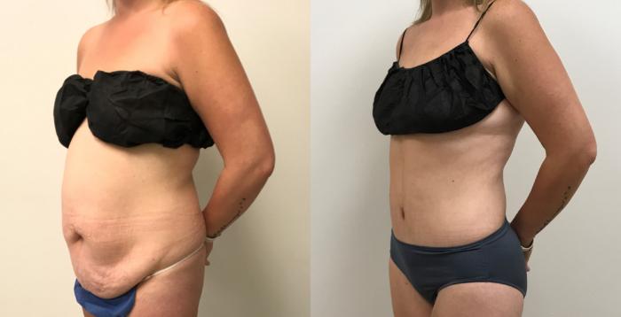 Before & After Liposuction Case 374 Left Oblique View in Barrington, Illinois