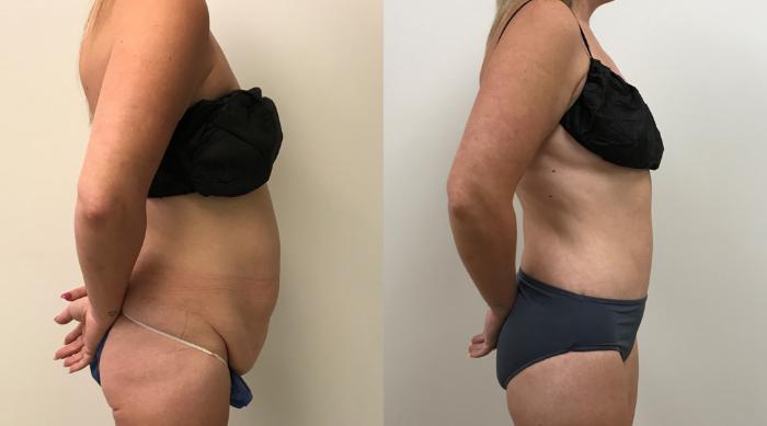 Before & After Circumferential Body Lift  Case 374 Right Side View in Barrington, Illinois