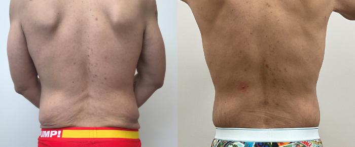Before & After Circumferential Body Lift  Case 391 Back View in Barrington, Illinois