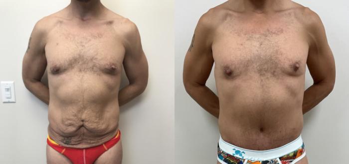 Before & After Circumferential Body Lift  Case 391 Front View in Barrington, Illinois