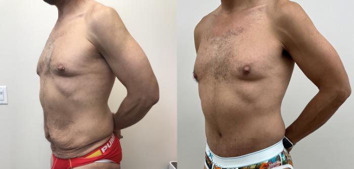 Before & After Circumferential Body Lift  Case 391 Left Oblique View in Barrington, Illinois