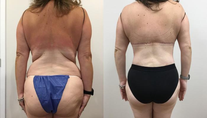 Before & After Circumferential Body Lift  Case 408 Back View in Barrington, Illinois