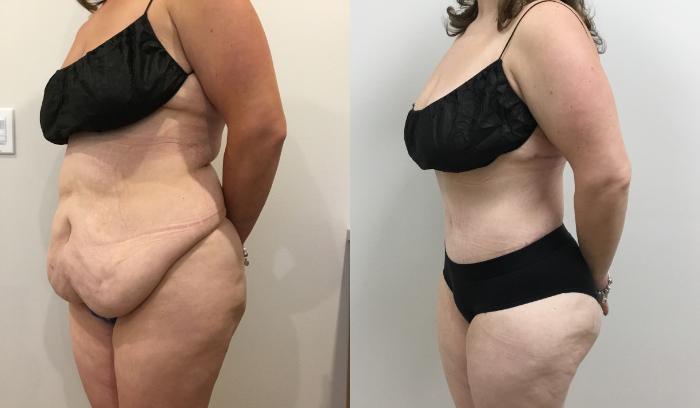 Before & After Circumferential Body Lift  Case 408 Left Oblique View in Barrington, Illinois