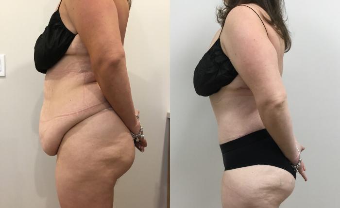 Before & After Circumferential Body Lift  Case 408 Left Side View in Barrington, Illinois