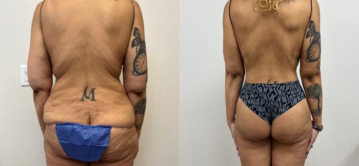 Before & After Circumferential Body Lift  Case 410 Back View in Barrington, Illinois