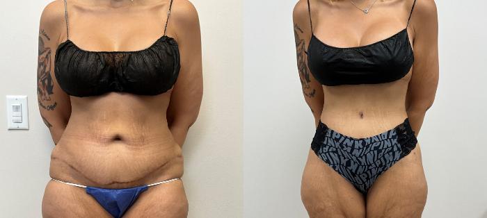 Before & After Circumferential Body Lift  Case 410 Front View in Barrington, Illinois