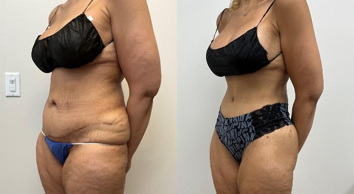 Before & After Circumferential Body Lift  Case 410 Left Oblique View in Barrington, Illinois