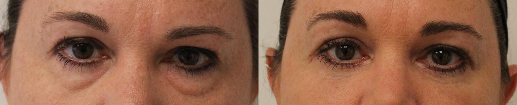 Before & After Eyelid Surgery (Blepharoplasty) Case 128 Front View in Barrington, Illinois