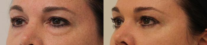 Before & After Eyelid Surgery (Blepharoplasty) Case 128 Left Oblique View in Barrington, Illinois
