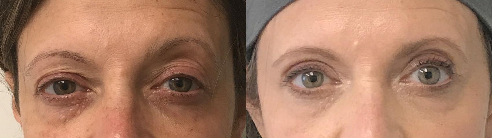 Before & After Eyelid Surgery (Blepharoplasty) Case 167 Front View in Barrington, Illinois