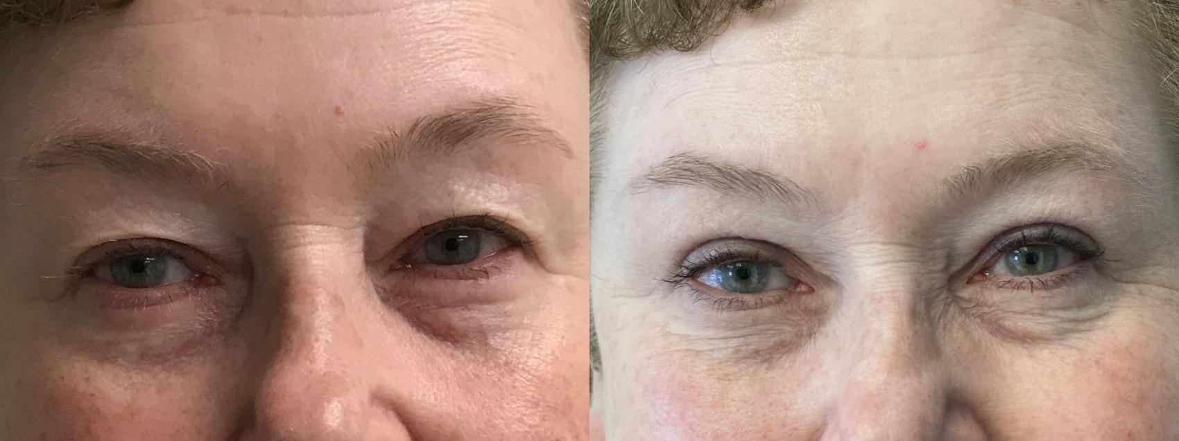 Before & After Eyelid Surgery (Blepharoplasty) Case 173 Front View in Barrington, Illinois