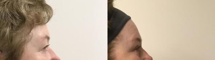 Before & After Eyelid Surgery (Blepharoplasty) Case 173 Right Side View in Barrington, Illinois