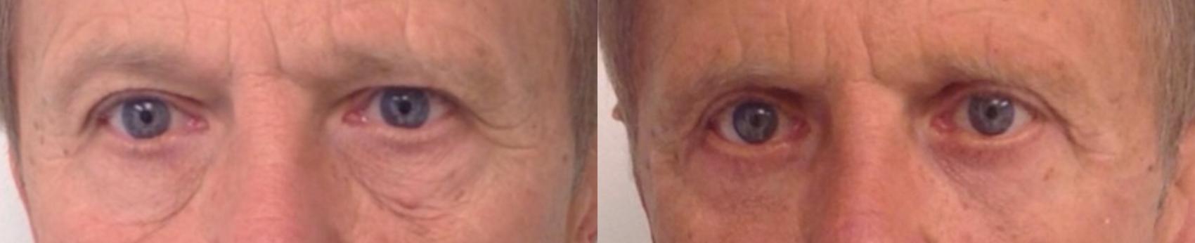 Before & After Eyelid Surgery (Blepharoplasty) Case 176 Front View in Barrington, Illinois