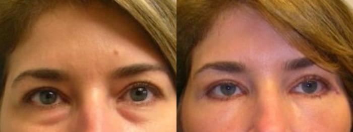 Before & After Eyelid Surgery (Blepharoplasty) Case 177 Front View in Barrington, Illinois
