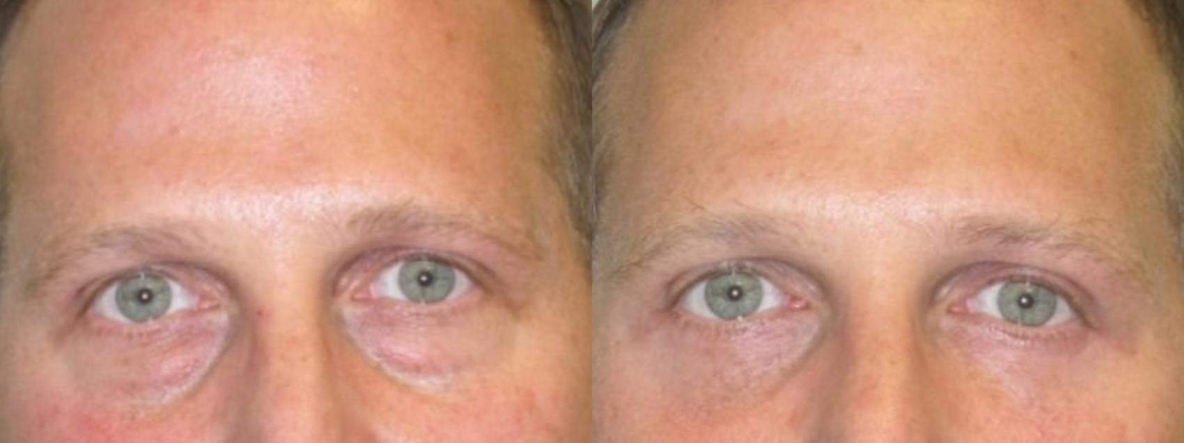 Before & After Eyelid Surgery (Blepharoplasty) Case 178 Front View in Barrington, Illinois
