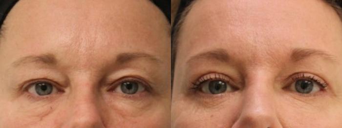 Before & After Eyelid Surgery (Blepharoplasty) Case 179 Front View in Barrington, Illinois