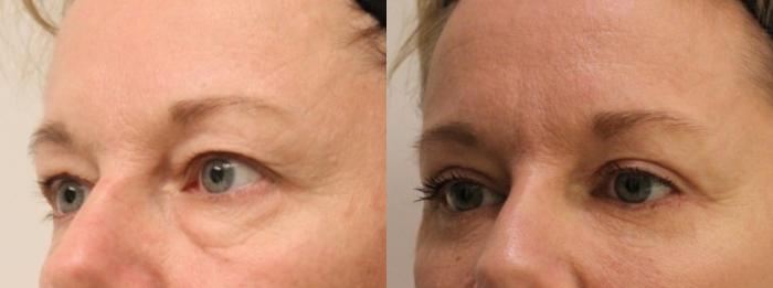 Before & After Eyelid Surgery (Blepharoplasty) Case 179 Left Oblique View in Barrington, Illinois