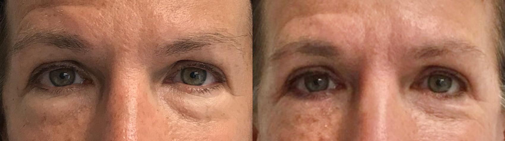 Before & After Eyelid Surgery (Blepharoplasty) Case 181 Front View in Barrington, Illinois