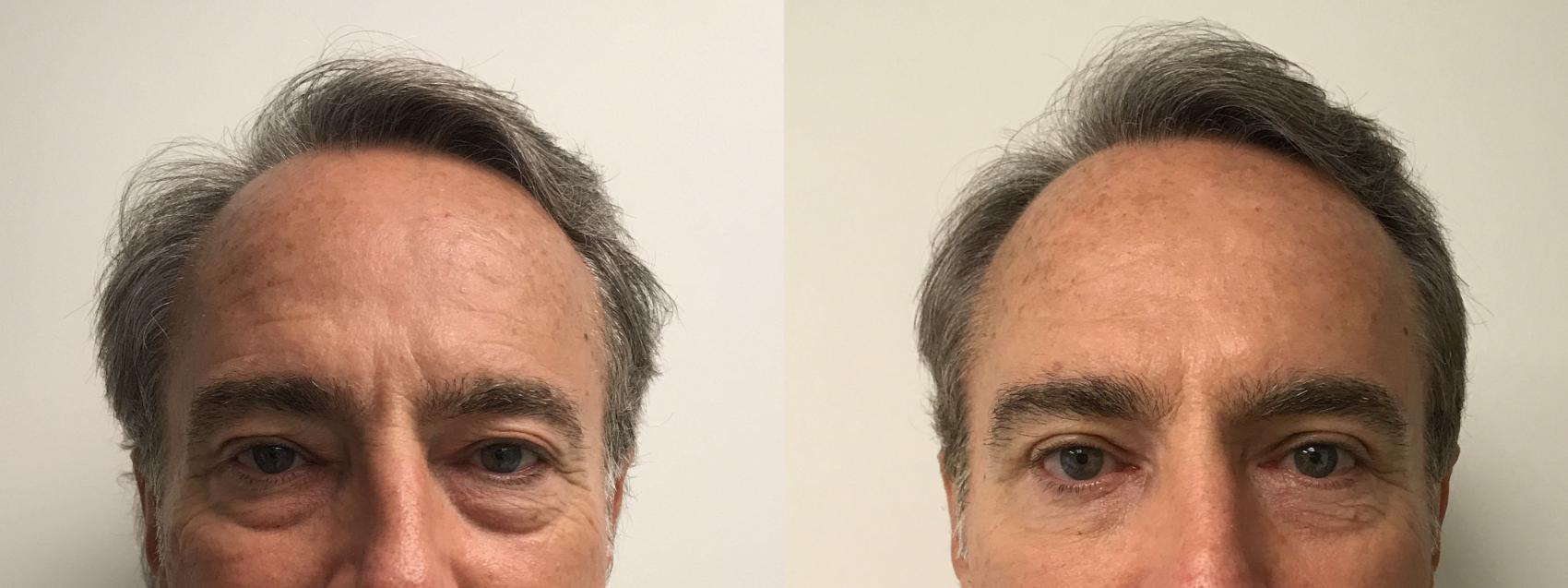 Before & After Eyelid Surgery (Blepharoplasty) Case 224 Front View in Barrington, Illinois