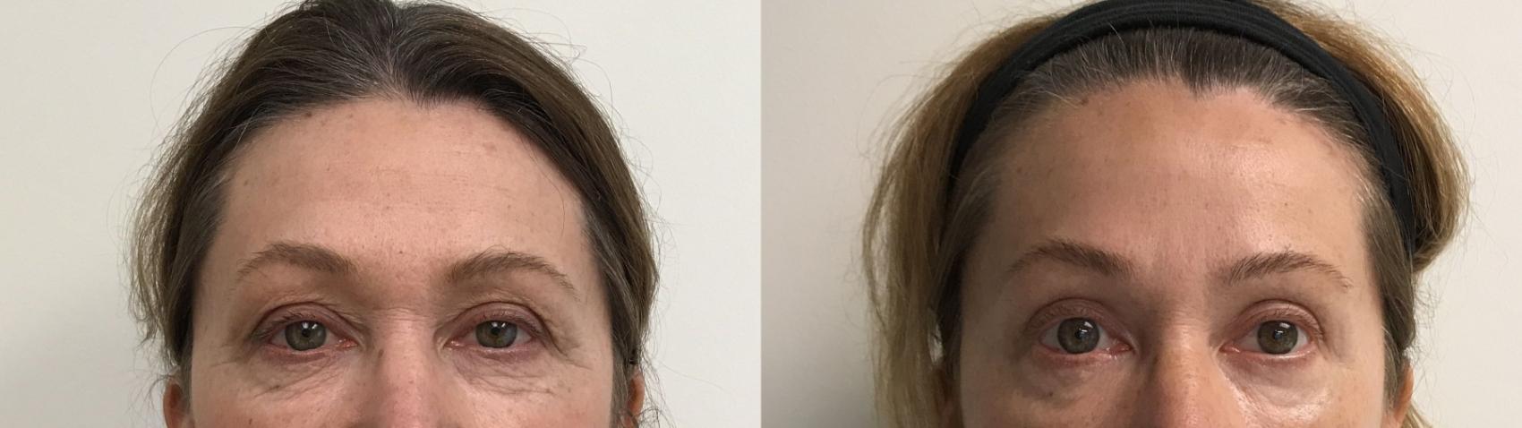 Before & After Eyelid Surgery (Blepharoplasty) Case 241 Front View in Barrington, Illinois