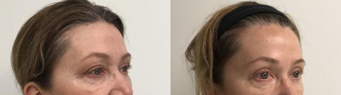 Before & After Eyelid Surgery (Blepharoplasty) Case 241 Left Oblique View in Barrington, Illinois