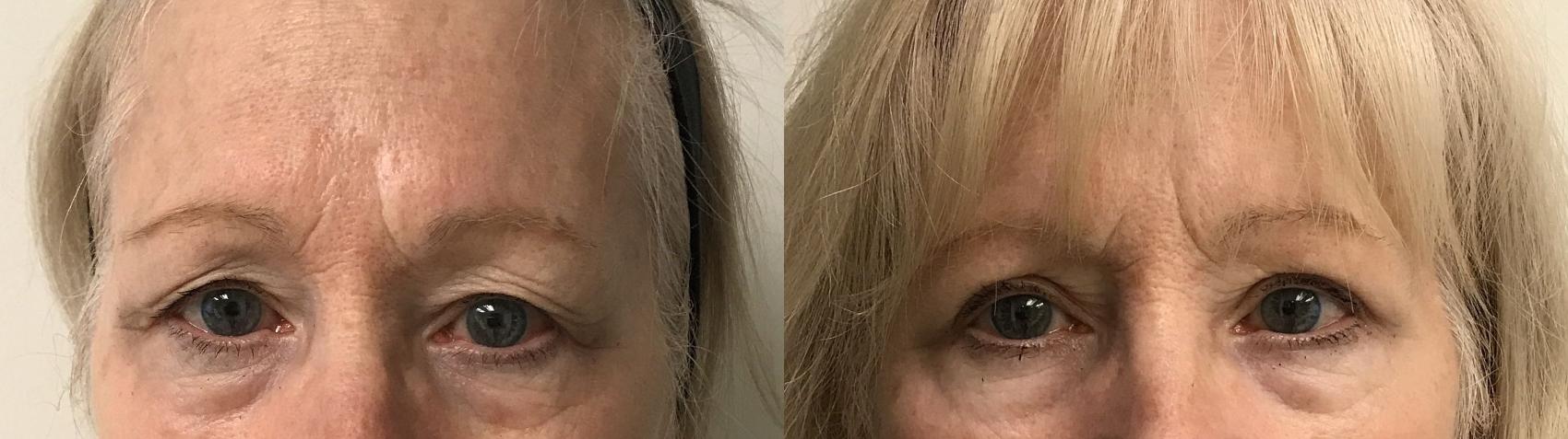 Before & After Eyelid Surgery (Blepharoplasty) Case 251 Front View in Barrington, Illinois
