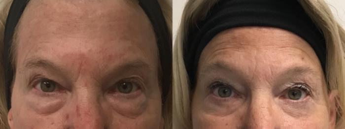 Before & After Eyelid Surgery (Blepharoplasty) Case 276 Front View in Barrington, Illinois