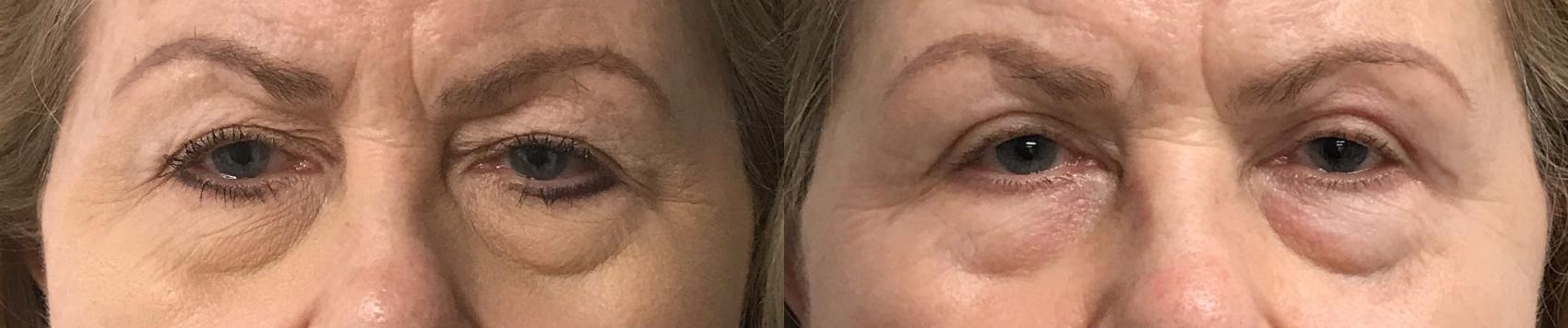 Before & After Eyelid Surgery (Blepharoplasty) Case 278 Front View in Barrington, Illinois