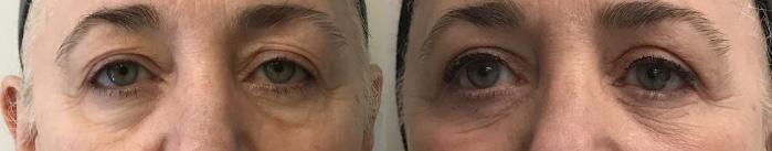 Before & After Eyelid Surgery (Blepharoplasty) Case 279 Front View in Barrington, Illinois
