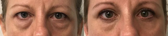Before & After Eyelid Surgery (Blepharoplasty) Case 289 Front View in Barrington, Illinois