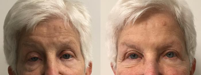 Before & After Eyelid Surgery (Blepharoplasty) Case 304 Front View in Barrington, Illinois