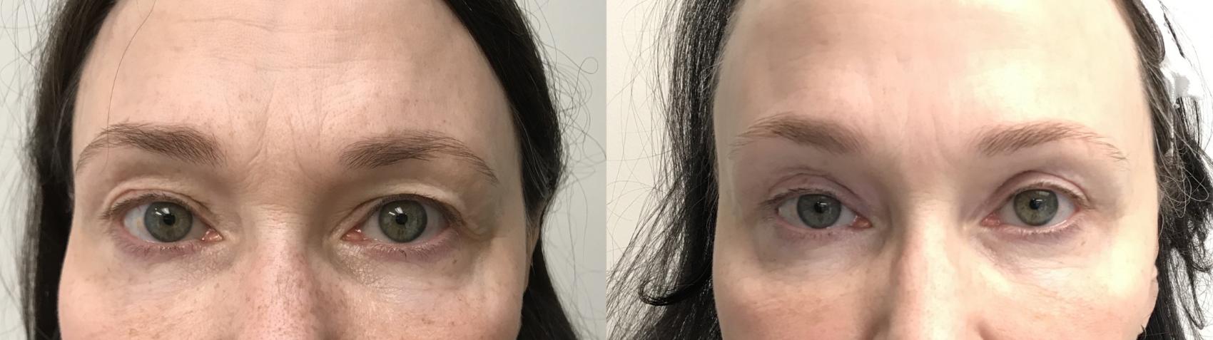 Before & After Eyelid Surgery (Blepharoplasty) Case 305 Front View in Barrington, Illinois