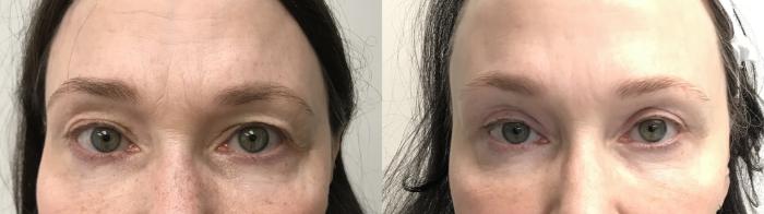 Before & After Eyelid Surgery (Blepharoplasty) Case 305 Front View in Barrington, Illinois