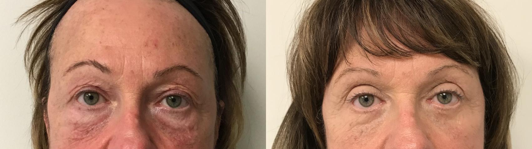 Before & After Eyelid Surgery (Blepharoplasty) Case 306 Front View in Barrington, Illinois