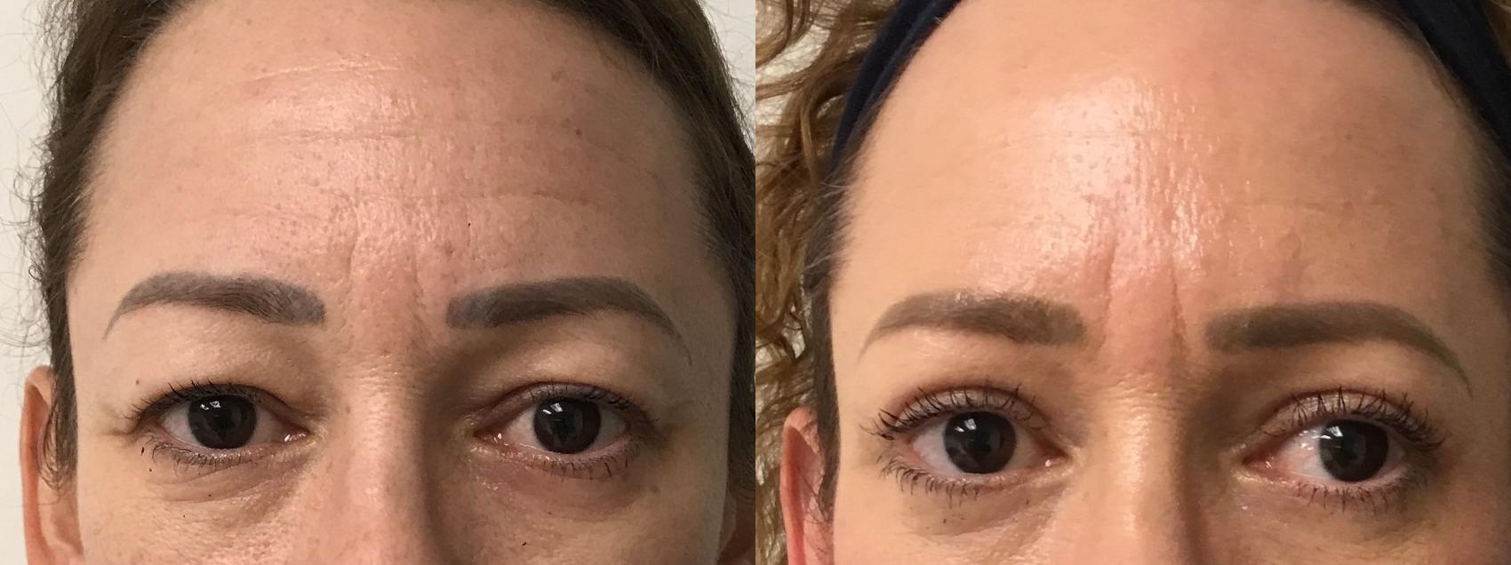 Before & After Eyelid Surgery (Blepharoplasty) Case 318 Front View in Barrington, Illinois