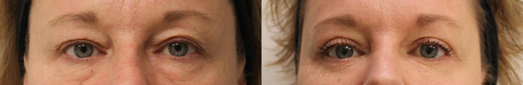 Before & After Eyelid Surgery (Blepharoplasty) Case 33 View #1 View in Barrington, Illinois